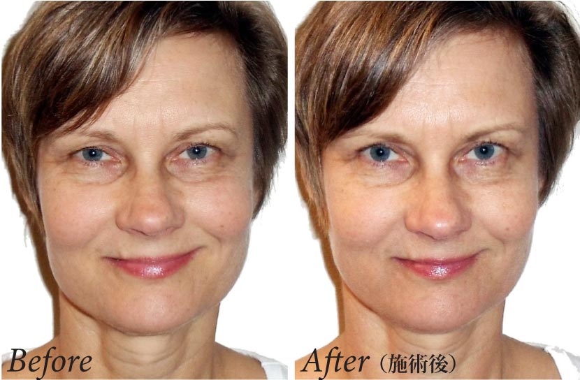 Lymphatic Drainage Face Before And After Manual Lymphatic Drainage After Facelift Best Drain