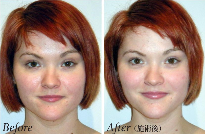 Lymphatic Drainage Face Before And After Best Drain Photos